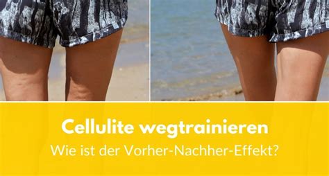 senfsalbe vorher-nachher|Lymphdrainage bei Cellulite: Der Vorher